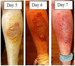 Day 5, 6 and 7 of hogweed burns on a man's leg