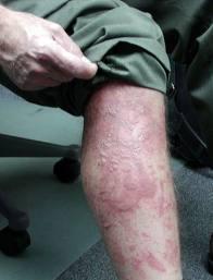 Hogweed burns on a man's leg